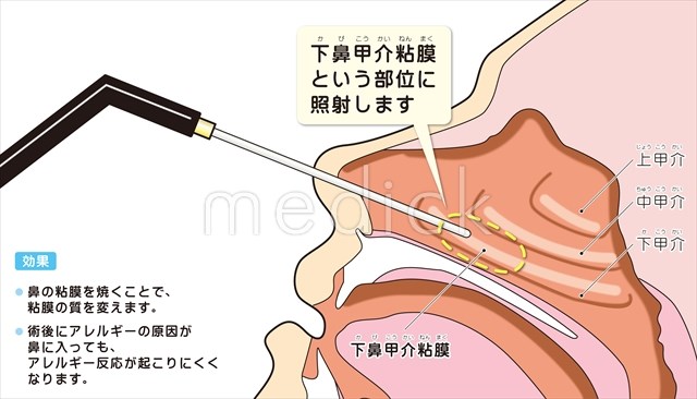 鼻づまり奮闘記